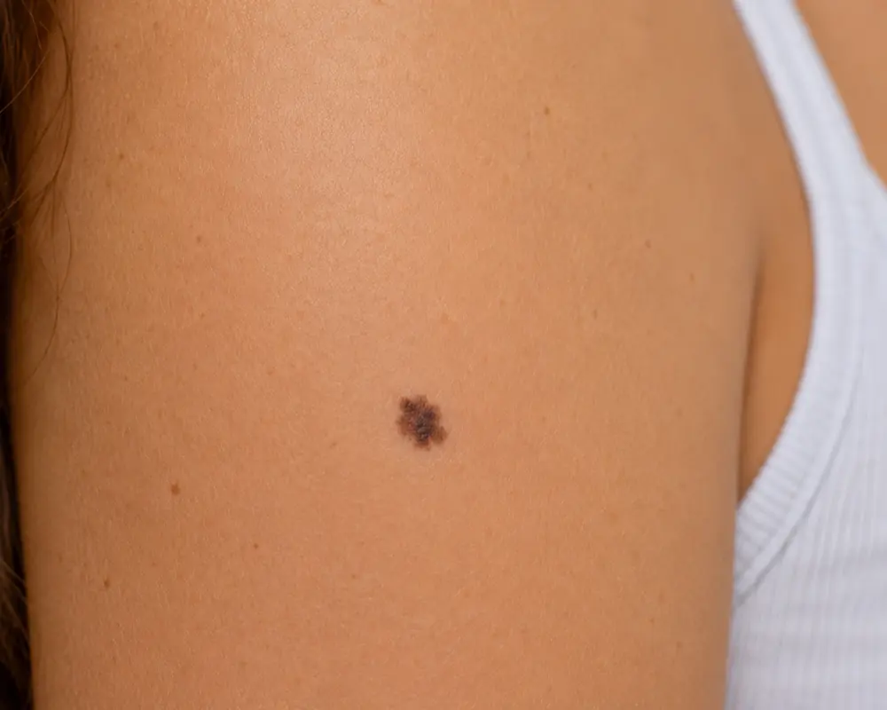 A melanoma skin lesion showing irregular borders and colour