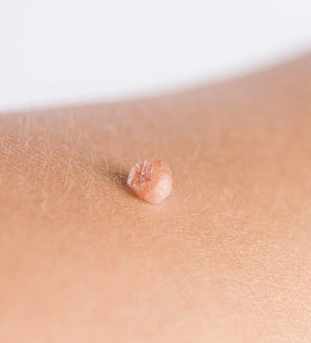 Close-up of a skin tag on the skin