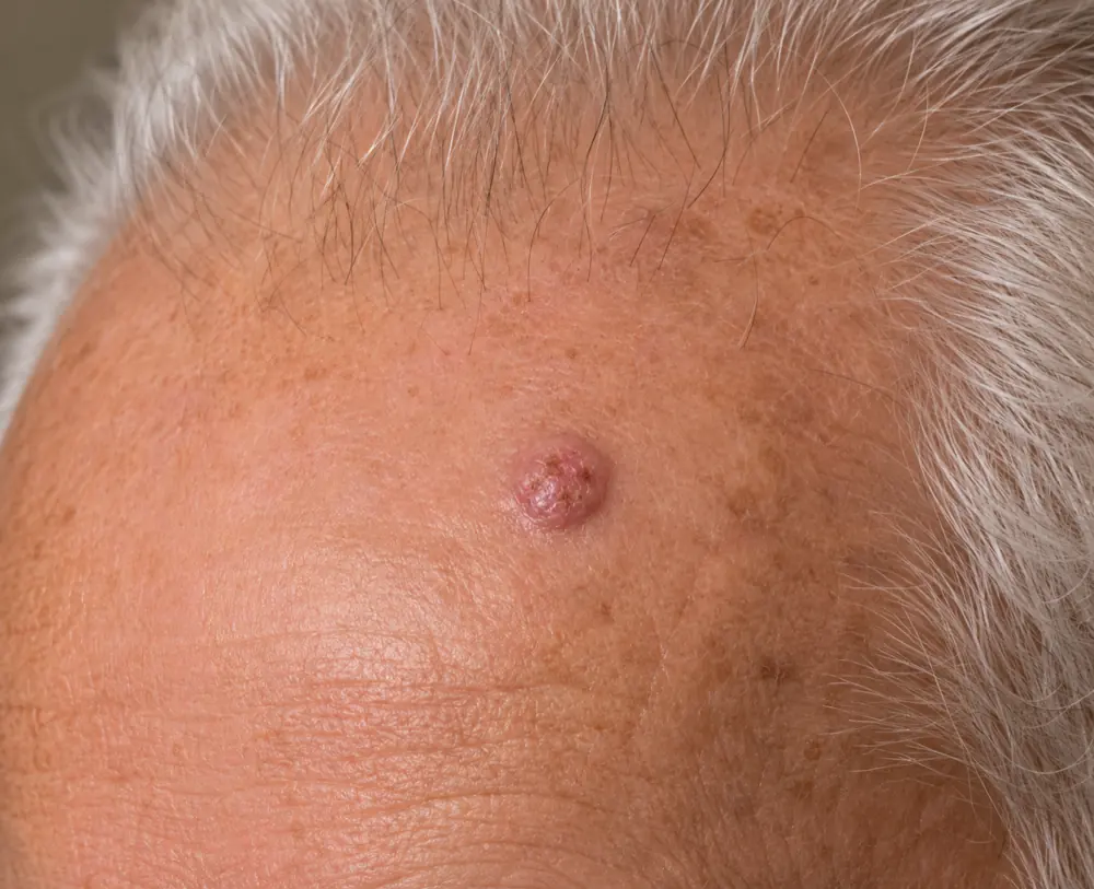 A squamous cell carcinoma lesion on sun-exposed skin