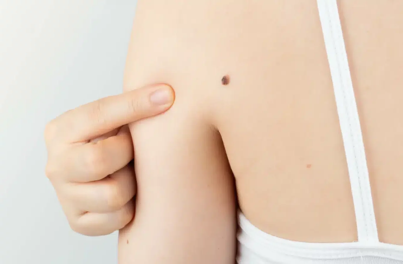Mole on Back - Assessment and Mole Removal Edinburgh