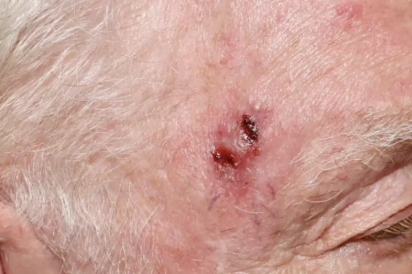 basal cell carcinoma on face removal