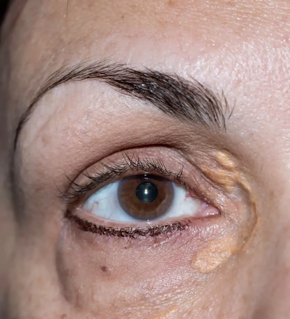 xanthelasma on eyelids